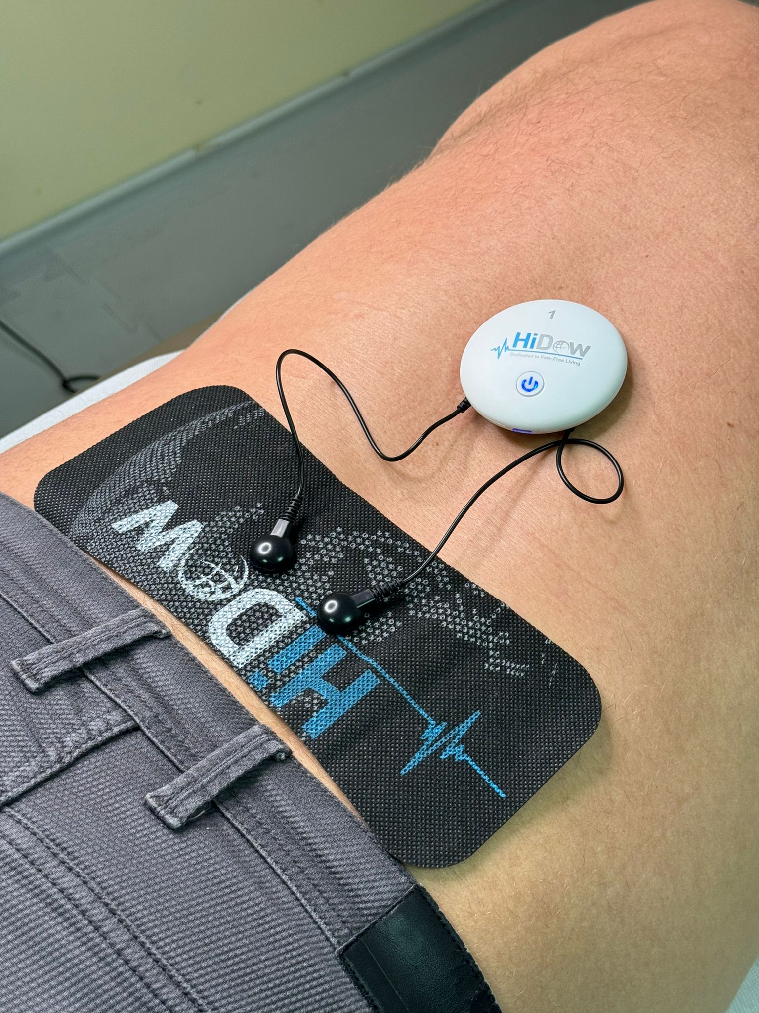 Transkutāna elektroneirostimulācija TENS